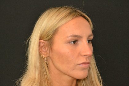 Rhinoplasty Before & After Patient #19847