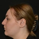 Rhinoplasty Before & After Patient #19847