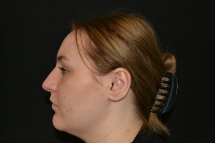 Rhinoplasty Before & After Patient #19847