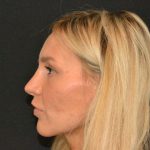 Rhinoplasty Before & After Patient #19847