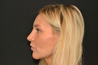 Rhinoplasty Before & After Patient #19847