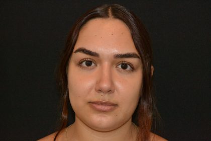 Rhinoplasty Before & After Patient #19848