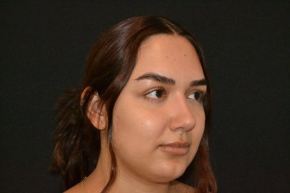 Rhinoplasty Before & After Patient #19848