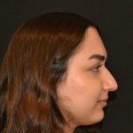 Rhinoplasty Before & After Patient #19848