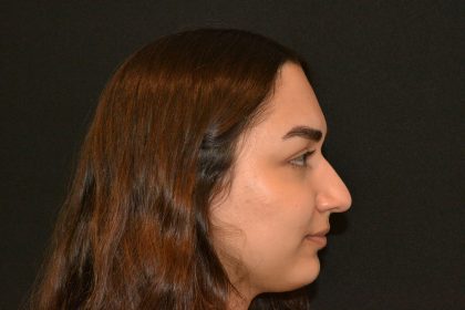 Rhinoplasty Before & After Patient #19848
