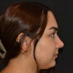 Rhinoplasty Before & After Patient #19848