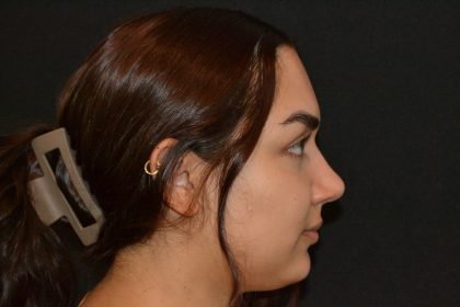 Rhinoplasty Before & After Patient #19848
