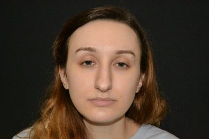Rhinoplasty Before & After Patient #19849