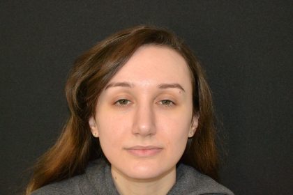Rhinoplasty Before & After Patient #19849