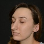 Rhinoplasty Before & After Patient #19849