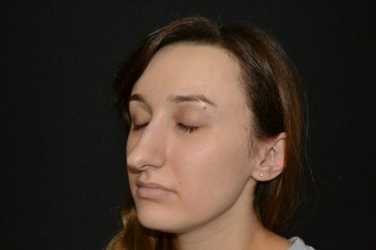 Rhinoplasty Before & After Patient #19849
