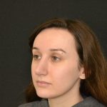 Rhinoplasty Before & After Patient #19849