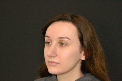 Rhinoplasty Before & After Patient #19849