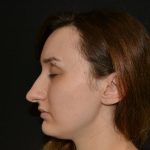 Rhinoplasty Before & After Patient #19849