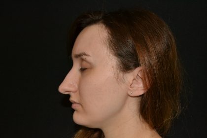 Rhinoplasty Before & After Patient #19849