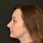 Rhinoplasty Before & After Patient #19849