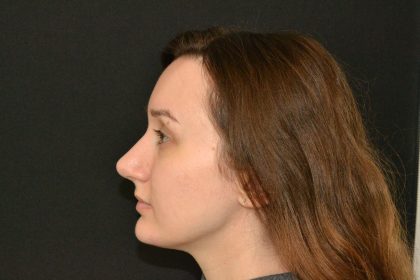 Rhinoplasty Before & After Patient #19849