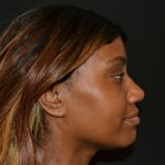 Rhinoplasty Before & After Patient #19850