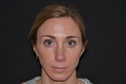 Revision Rhinoplasty Before & After Patient #19851
