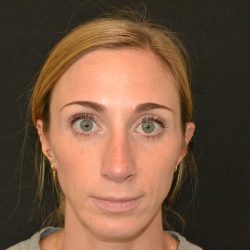 Revision Rhinoplasty Before & After Patient #19851