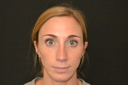 Revision Rhinoplasty Before & After Patient #19851