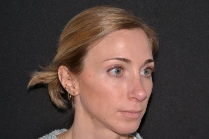 Revision Rhinoplasty Before & After Patient #19851