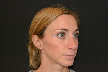 Revision Rhinoplasty Before & After Patient #19851