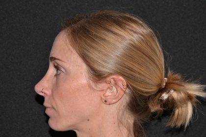 Revision Rhinoplasty Before & After Patient #19851