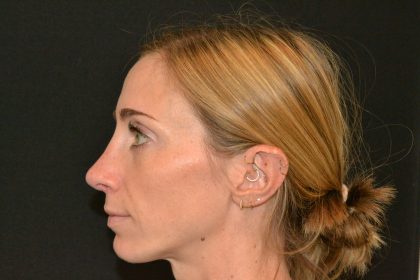 Revision Rhinoplasty Before & After Patient #19851