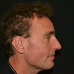 Rhinoplasty Before & After Patient #19852
