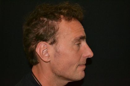 Rhinoplasty Before & After Patient #19852