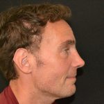 Rhinoplasty Before & After Patient #19852