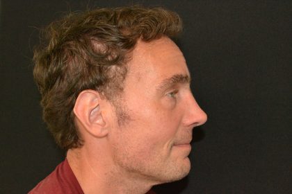 Rhinoplasty Before & After Patient #19852
