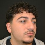 Rhinoplasty Before & After Patient #19853