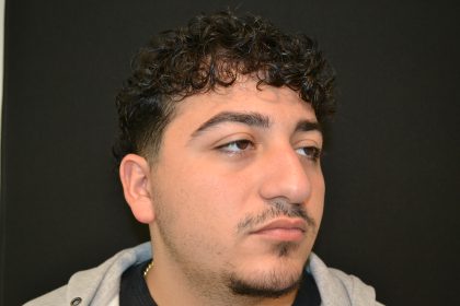 Rhinoplasty Before & After Patient #19853