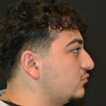 Rhinoplasty Before & After Patient #19853