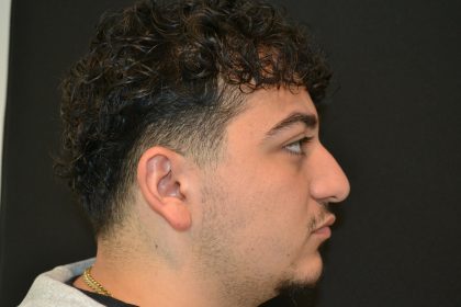 Rhinoplasty Before & After Patient #19853
