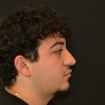 Rhinoplasty Before & After Patient #19853