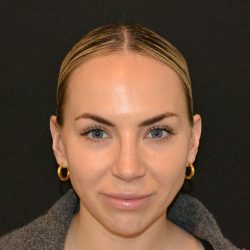 Rhinoplasty Before & After Patient #19854