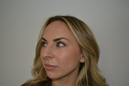 Rhinoplasty Before & After Patient #19854