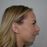 Rhinoplasty Before & After Patient #19854