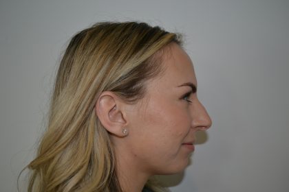 Rhinoplasty Before & After Patient #19854