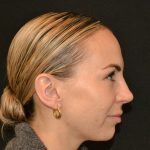 Rhinoplasty Before & After Patient #19854