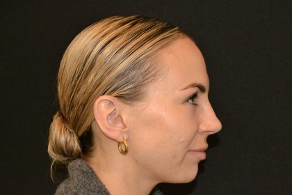 Rhinoplasty Before & After Patient #19854