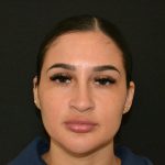 Rhinoplasty Before & After Patient #19855