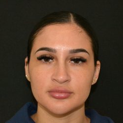 Rhinoplasty Before & After Patient #19855