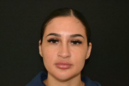Rhinoplasty Before & After Patient #19855
