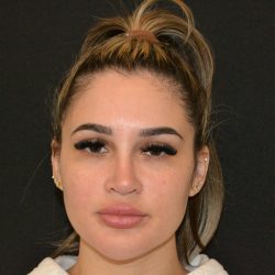 Rhinoplasty Before & After Patient #19855