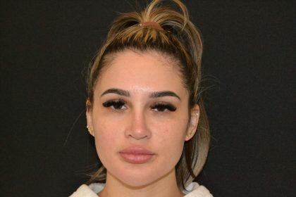 Rhinoplasty Before & After Patient #19855