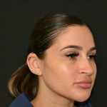 Rhinoplasty Before & After Patient #19855